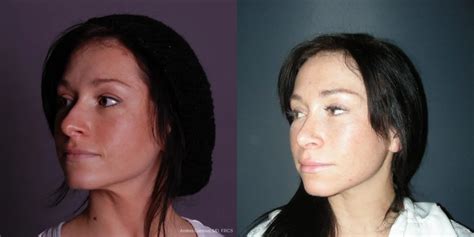 Rhinoplasty Before And After Gallery Patient 46