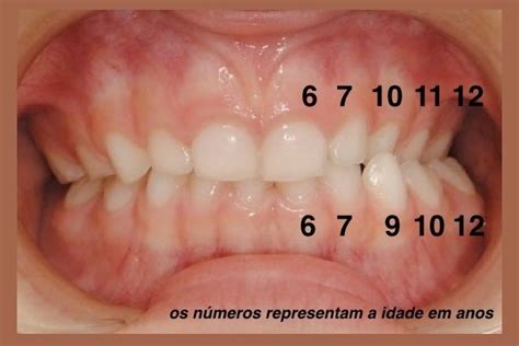 Quanto Tempo Demora Para Nascer Um Dente Tua Sa De