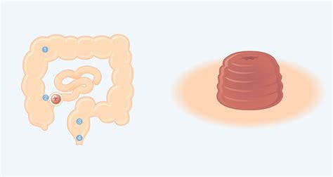 Loop Ileostomy