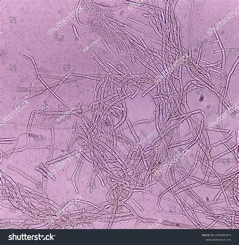 Microscopic Fungi Malassezia Furfur Showing Yeast Stock Photo