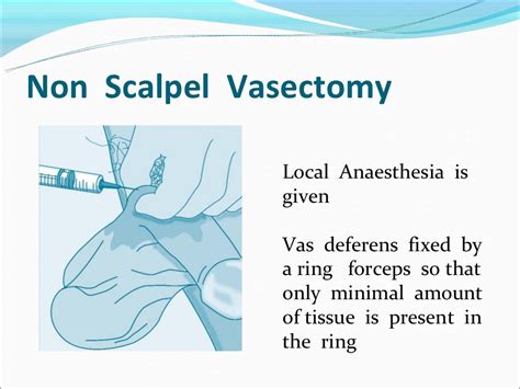 No Scalpel Vasectomy