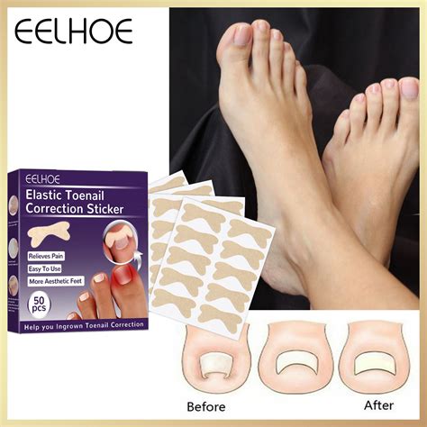 Eelhoe Elastic Toenail Correction Stickers Ingrown Toenail Corrector