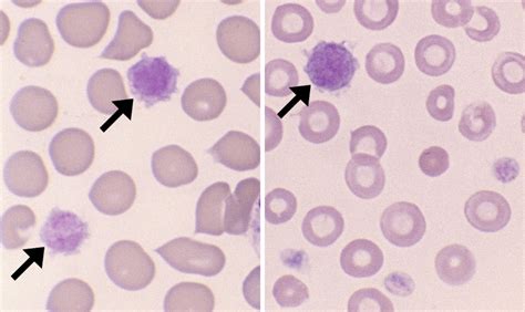 Giant Platelet – Cells and Smears