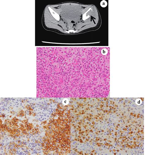 Case 5. The CT examination reveals osteolytic lesion in the iliac bones ...