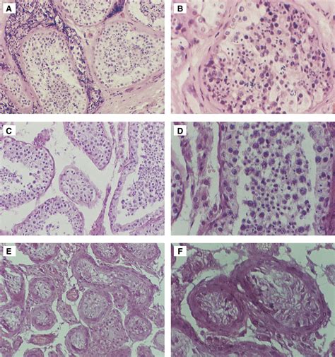 Histopathologic Patterns Of Testicular Biopsies In Infertile