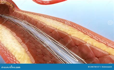 Angioplasty And Vascular Stenting Stock Illustration Illustration Of