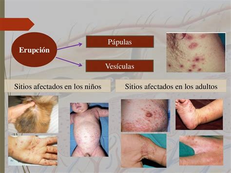 Lesiones Escabiosis