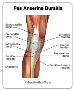 Pes Anserine Bursitis - Mississauga Chiropractor and Physiotherapy Clinic - FREE Consult!