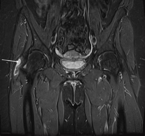 Coronal Magnetic Resonance T2 Stir Image Of The Right T Open I