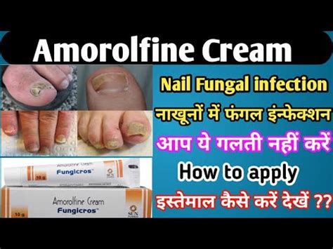 Amorolfine Cream Nail Lacquer How To Use Fungicros Cream Use How To