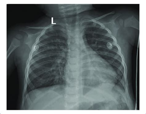 Portable Anteroposterior Chest X Ray On Admission Ten Bilateral