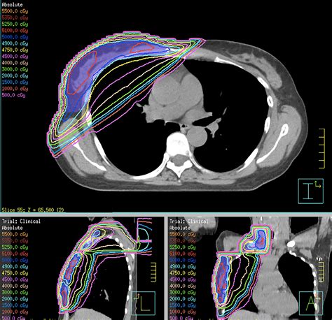 Volumetric Arc Therapy A Viable Option For Right Sided Breast With