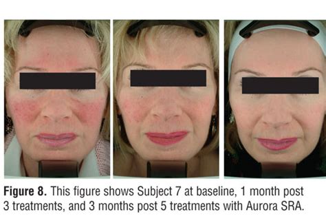 Successful Treatment Of Erythematotelangiectatic Rosacea With Pulsed