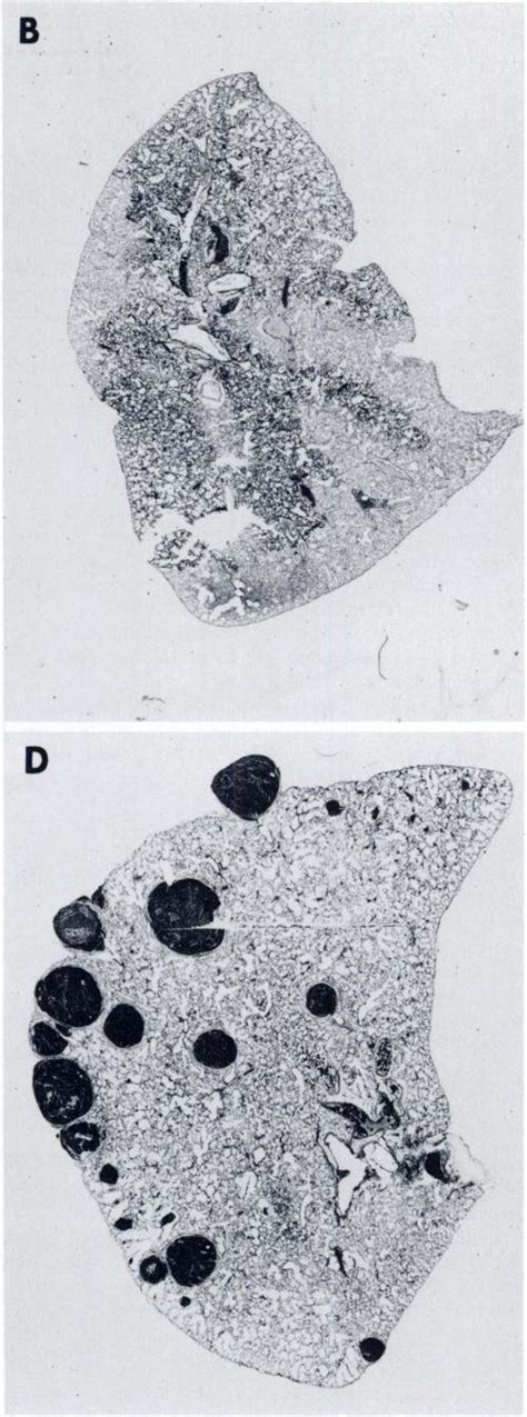 Histol Gica Sections Of Lung Inflated Post Mortem Specimens From A