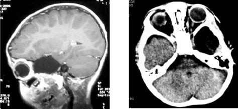 Posterior Fossa Arachnoid Cyst MRI