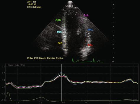 Example Of Left Ventricular Lv Strain Measurement In The Apical