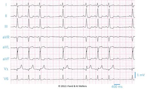 pqqrs ecg cafe