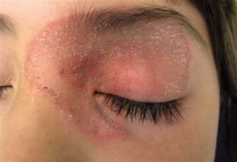 Rash On Eyelid Pictures Causes And Treatment