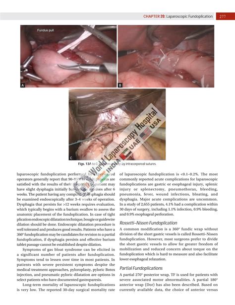 Laparoscopic Fundoplication at World Laparoscopy Hospital | PDF