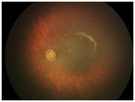 Fungal Chorioretinitis With Systemic Candidiasis In An Infant Following