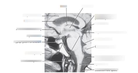 Brainstem MRI Diagram | Quizlet