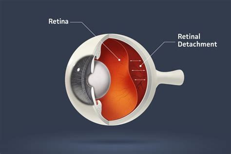 What Is Hemianopia (Hemianopsia)? - Facty Health