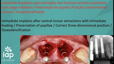 Implantes imediatos após extrações dos incisivos centrais superiores