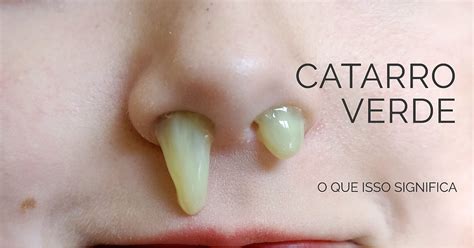 Catarro Verde Na Sinusite Causas Sintomas E Tratamento