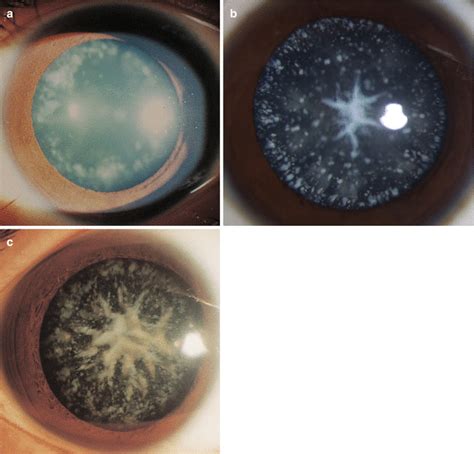 Sutural Cataract Types - Get Images