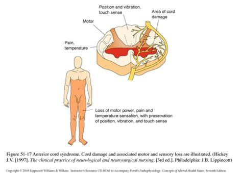 Spinal Core Injuries Flashcards Quizlet