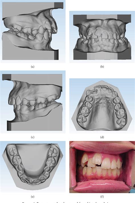 Table 1 From Orthodontic Treatment Of Ankylosed Maxillary Incisor Through Osteogenic Distraction