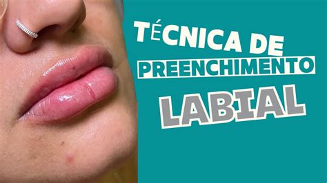 Técnica De Preenchimento Labial Youtube