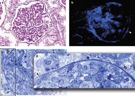 Dense Deposit Disease Is Not A Membranoproliferative Glomerulonephritis