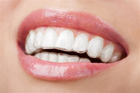 Orthognathic Surgery With Invisalign It Is Possible Instituto