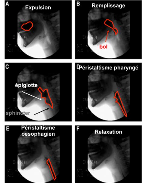 12 Séquences de la déglutition visualisées par radiographie Issu de