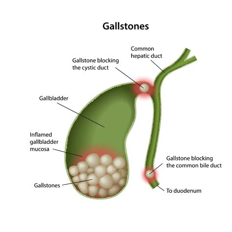 Gallstones Problems In Singapore Endoscopy Treatment Singapore