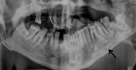 Osteoradionecrosis Of The Mandible Through A Radiologists Eyes