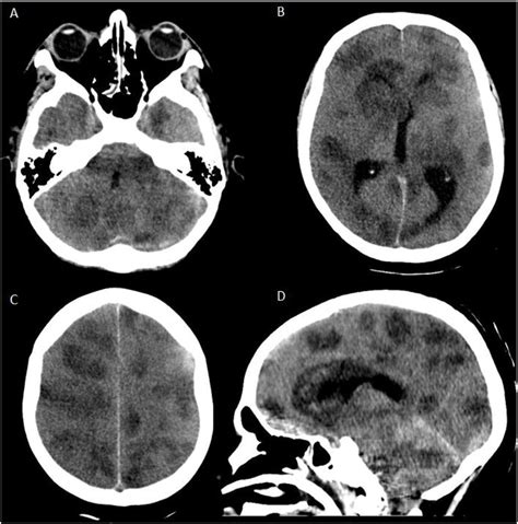 Brain Ct Showing Multiple Supra And Infratentorial Hypodense Lesions