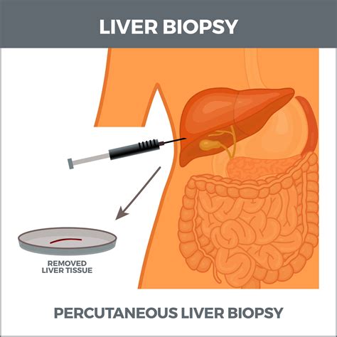 Biopsies Gastro Md