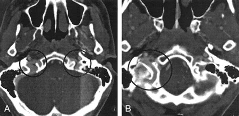 Diagnostic Pitfall Atypical Cerebral Venous Drainage Via The Vertebral