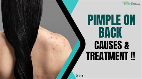 Acnepimple On The Shoulders And Back Know The Causes And Treatment