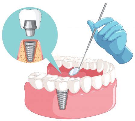 Cuánto valen los implantes en realidad Clínica Dental CEMEQ