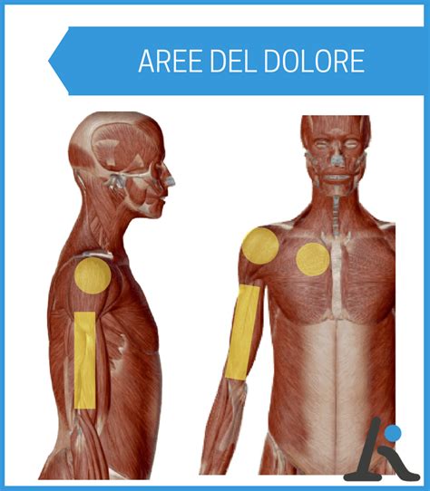 Infiammazione Cuffia Dei Rotatori Quanto Dura