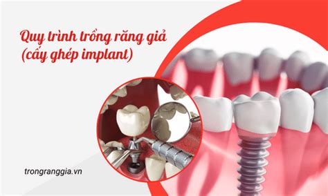 Quy trình trồng răng giả cấy ghép implant đạt chuẩn tại Nha khoa