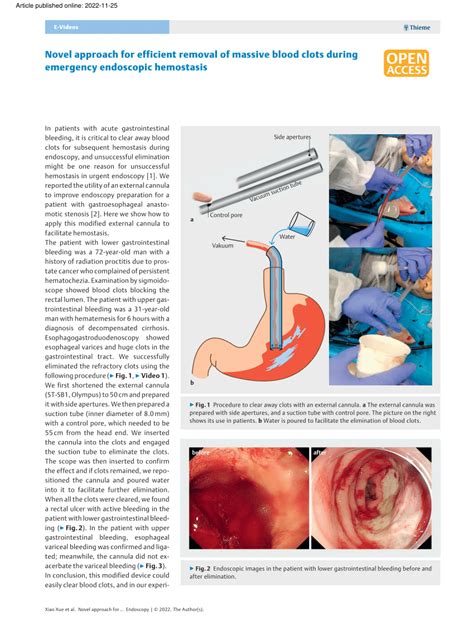 Pdf Novel Approach For Efficient Removal Of Massive Blood Clots