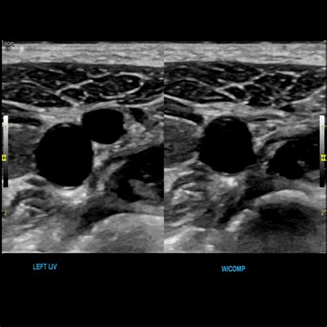 Upper Extremity Veins Ultrasound