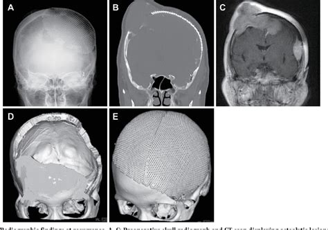 Figure 3 From A Case Of Recurrence Of Benign Convexity Primary