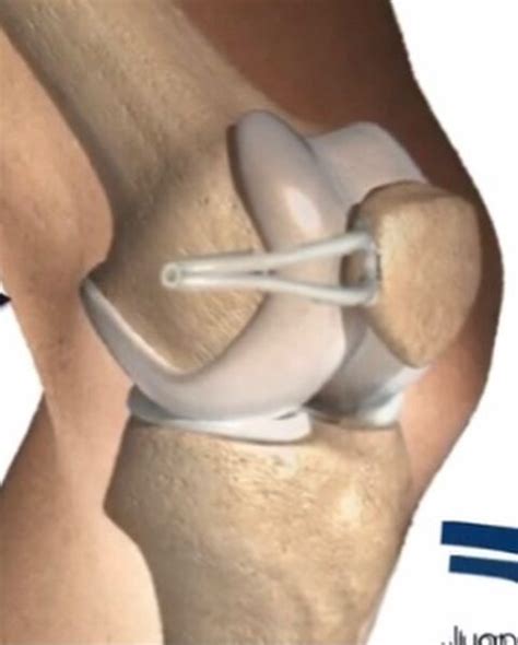 Injerto Patelo Femoral Medial Dr Jose Mario Dorantes Rodr Guez