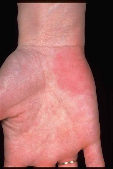 Palmar Erythema Causes Pictures Photos