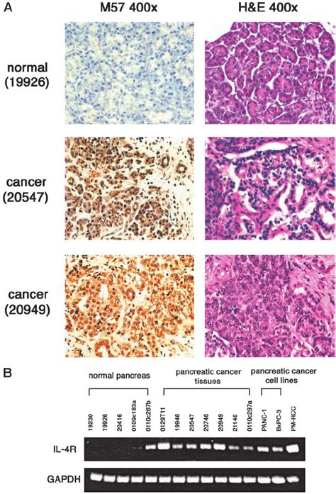 In Situ Expression Of Il R In Normal Pancreas And Cancer Tissue